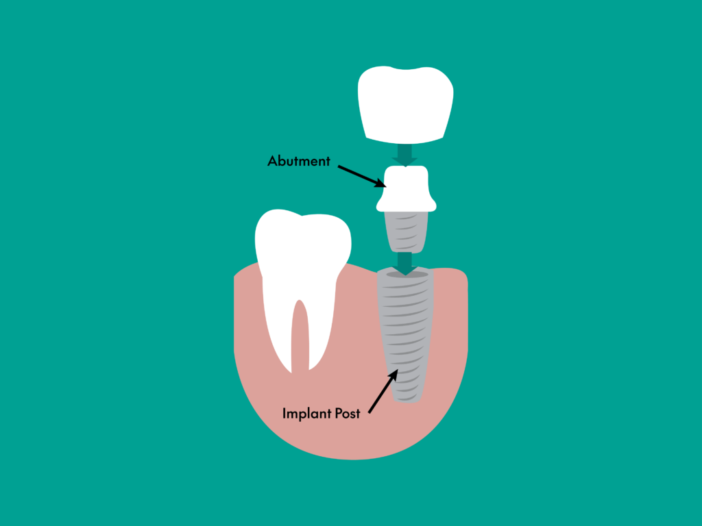 What Do Dental Implants Look Like?