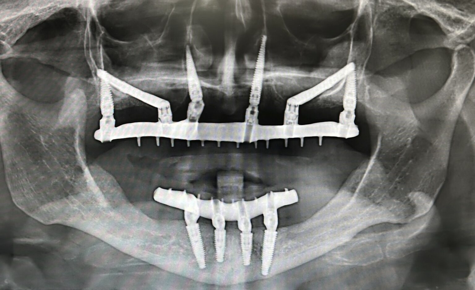 Zygomatic Implants Zygoma Dental Implant Surgery CDIC