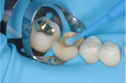 A rubber dam being used during a dental procedure.